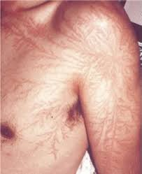 people with lightning scars